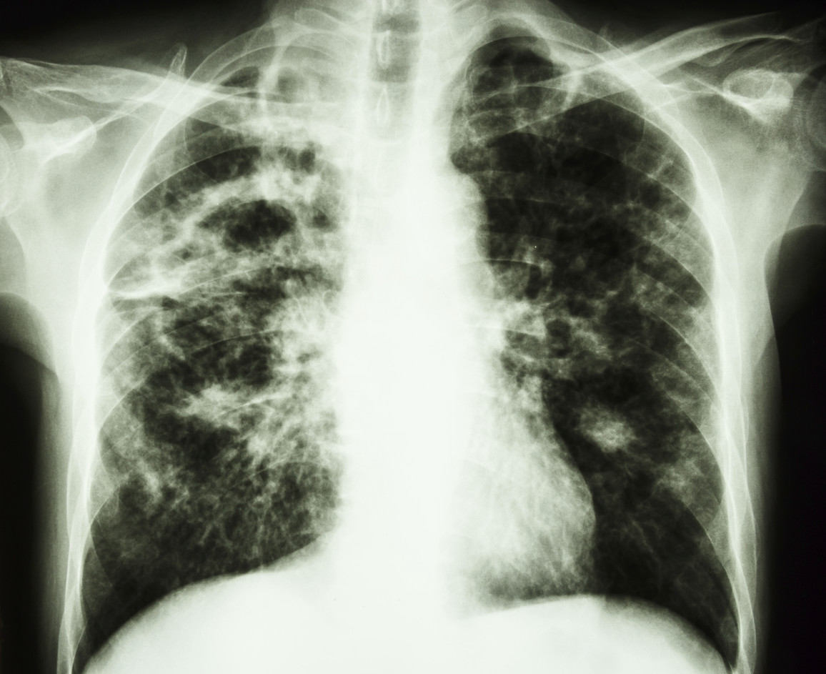 Легкие человека с туберкулезом. Туберкулез легких рентген. Рентгенография грудной клетки туберкулез. Рентген грудной клетки туберкулез. Рентгенограмма грудной клетки туберкулез.