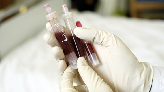 Die neue Methode zur Bekämpfung von Hautkrebs nutzt körpereigene Abwehrzellen, die sich im Blut befinden, Sie werden so verändert, dass sie die Krebszellen erkennen und vernichten können 